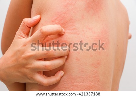 Women with symptoms of itchy urticaria. Royalty-Free Stock Photo #421337188