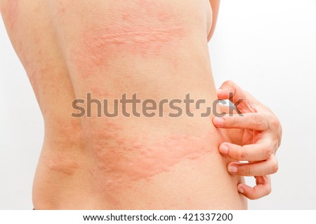 Women with symptoms of itchy urticaria. Royalty-Free Stock Photo #421337200