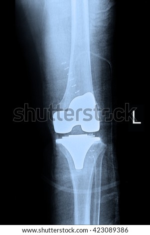 OA Knee : Cemented TKR Left Knee