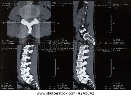 Macro of part of a rotational CT scan of a caucasian male spine area and pelvic joints.  Image shows a prolapse of disc L4/L5.  This is my own spine!