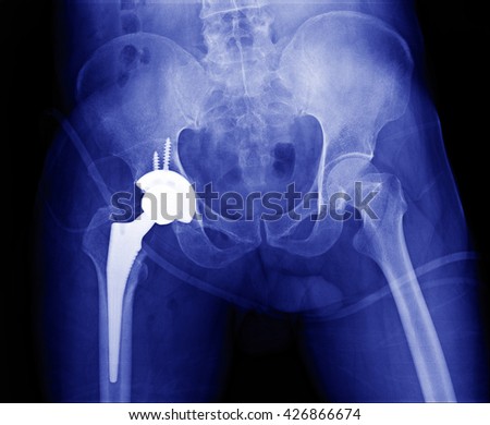 immediate postoperative x-ray image of both hip, anteroposterior view. Showing total 
Hip joint Replacement and hip prosthesis on right side. Royalty-Free Stock Photo #426866674