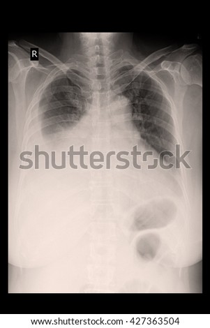chest xray show pleural effusion and infiltration both lung