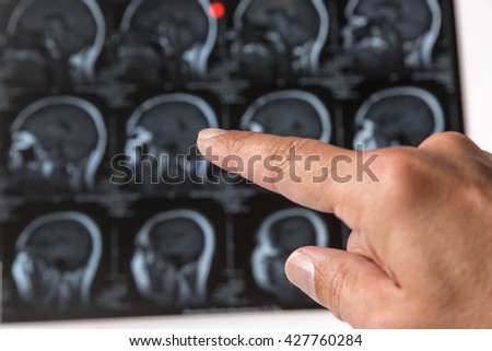 doctors hand pointing to x-ray picture of head