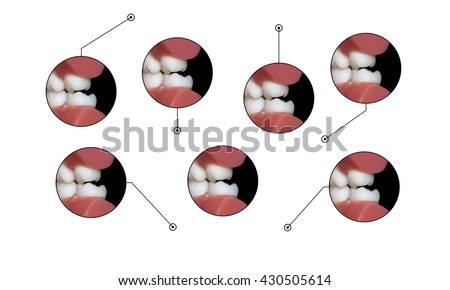 molars dental occlusion graphic elements callouts