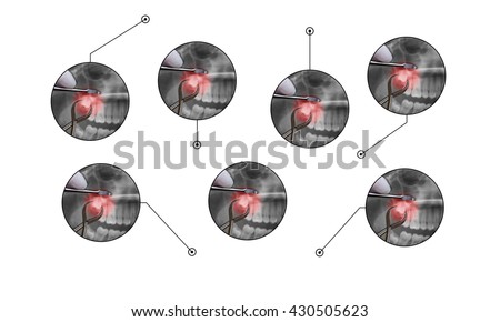 dentistry surgery extraction medical graphic illustration photo