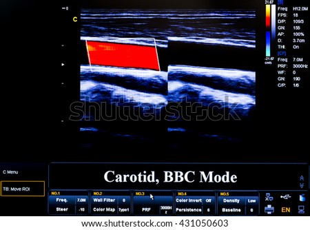 Modern echocardiography (ultrasound) machine monitor. Colour image. New hospitl equipment. Carotid artery.