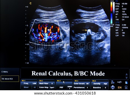 Modern echocardiography (ultrasound) machine monitor. Colour image. New hospitl equipment. Renal Calculus.