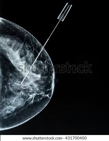 Mammogram Awareness: Wire guided (needle) localization of  a small breast cancer, identified by prior screening mammography.  The surgeon can locate the exact area for excisional biopsy (lumpectomy).  Royalty-Free Stock Photo #431700400