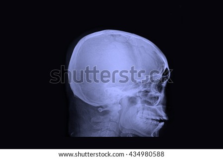X-RAY film of ,lateral skull bone
