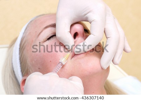 Procedure of lip injection with filler