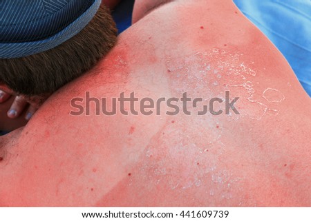 Sunburned male back