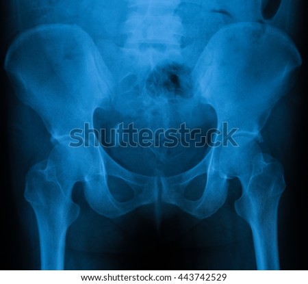 X-ray image of bladder, Showing bladder stone, female Royalty-Free Stock Photo #443742529