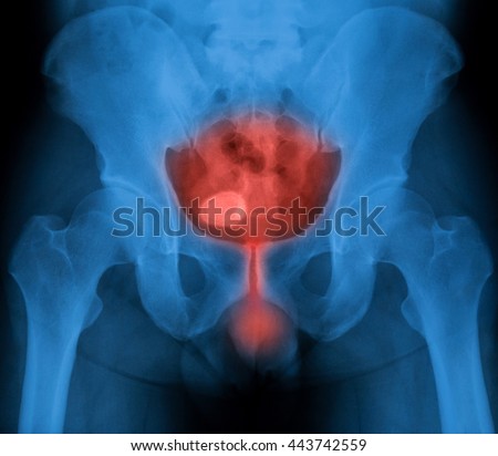 X-ray image of bladder, Showing urinary bladder and urethra infection, male  Royalty-Free Stock Photo #443742559