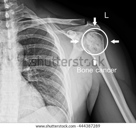 Bone cancer in  shoulder