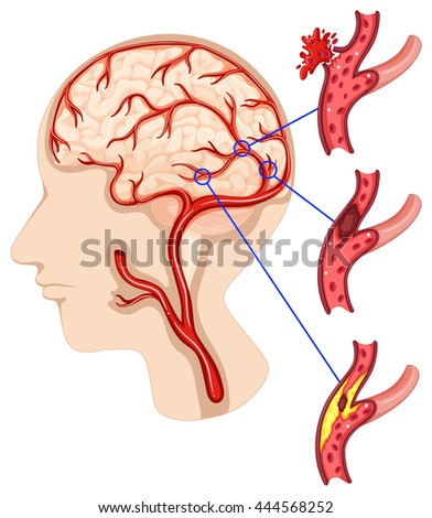 Caner in human brain illustration