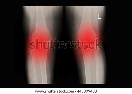 OA Knee ; Osteoporosis
