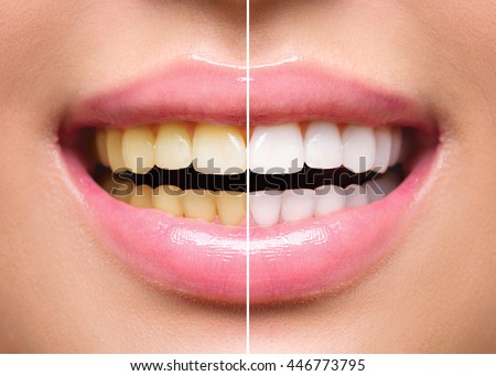 Woman Teeth Before and After Whitening. Happy smiling woman. Dental health Concept. Oral Care concept Royalty-Free Stock Photo #446773795