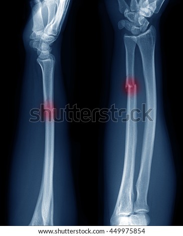 x-ray image show fracture  of ulnar bone in arm  at red area mark
