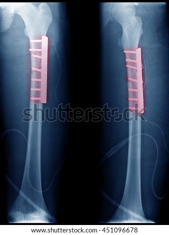 x-ray image of fracture femur bone , after reduction and internal fixation with plate and screw