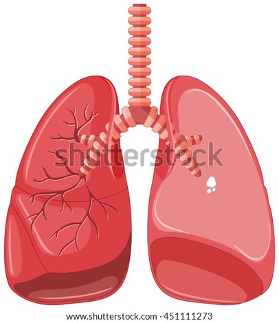 Human lungs with tuberculosis  illustration
