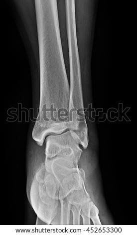 X-ray picture of ankle