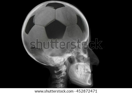 Radiography of skull with soccer ball inside