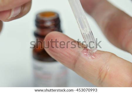 wart on finger with treatment by salicylic acid. wart on the finger verruca freeze concept blurred neutral background, selective focus, Royalty-Free Stock Photo #453070993