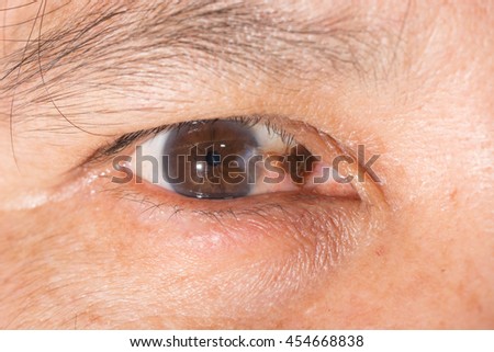 close up of the pterygium during eye examination.