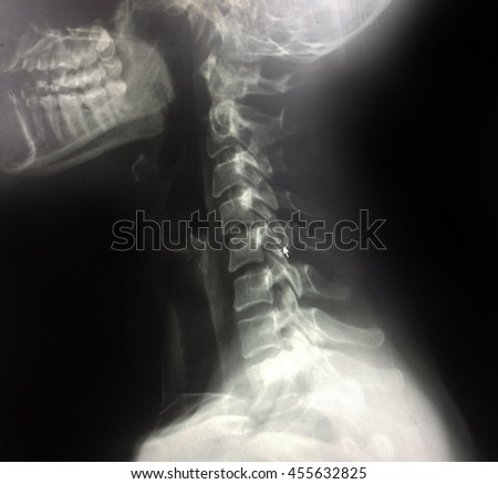 Xray Spinal Column and Skull Head