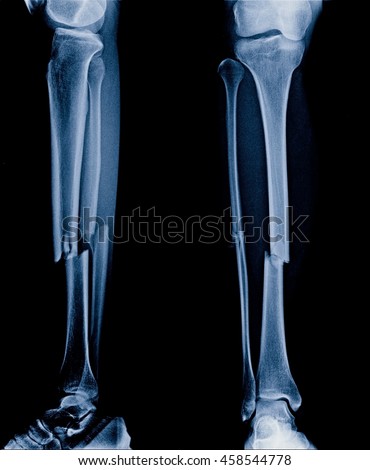 X-ray picture show fracture of tibia and fibula bone spiral type, Lateral side position x-ray picture