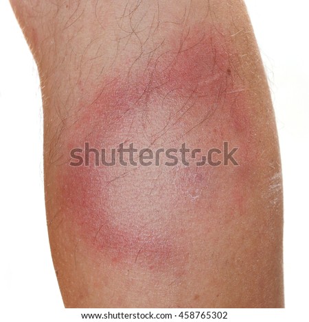 SOUTHERN-TICK-ASSOCIATED-RASH-ILLNESS Stock Photos and Images - Avopix.com