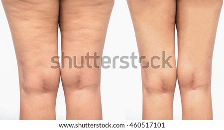 Cellulite  women. Figure of a young girl before and after. Royalty-Free Stock Photo #460517101