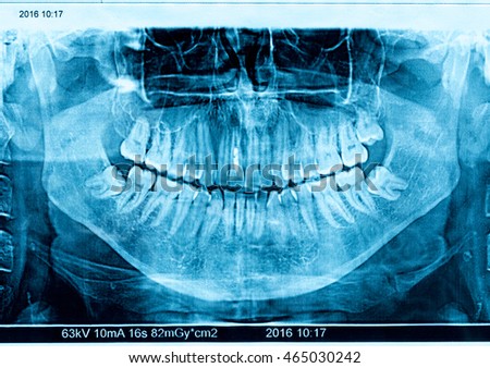 X-ray picture of human jaw with damaged teeth.