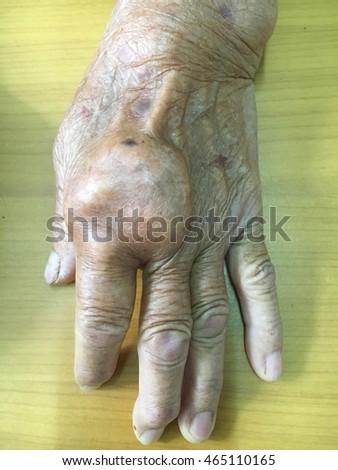 gouty disease Royalty-Free Stock Photo #465110165