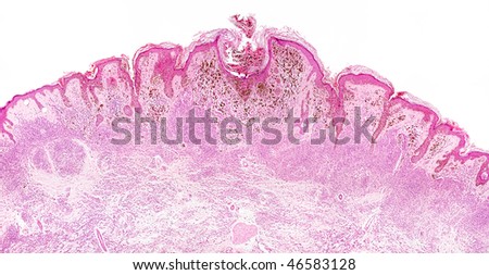 Malignant melanoma microscope picture