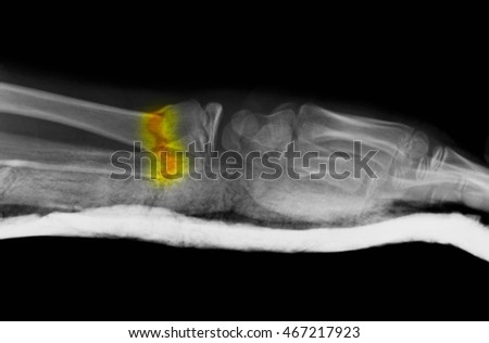 X-ray of a distal forearm fracture