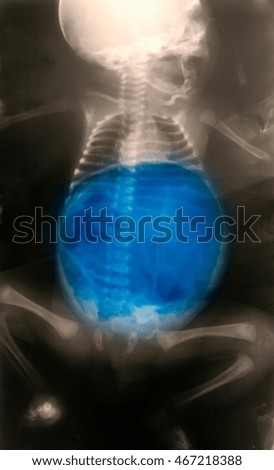 Body X-ray of newborn, perforation of the colon