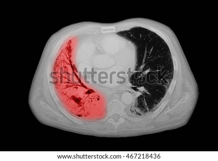 chest CT scan, small cell carcinoma, pneumonia