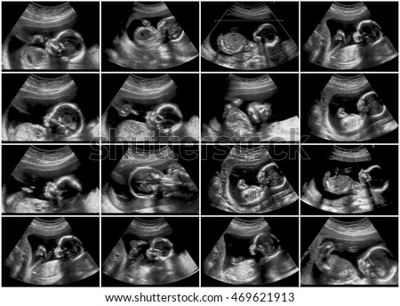 16 pictures collage of ultrasonography fetus scan Royalty-Free Stock Photo #469621913