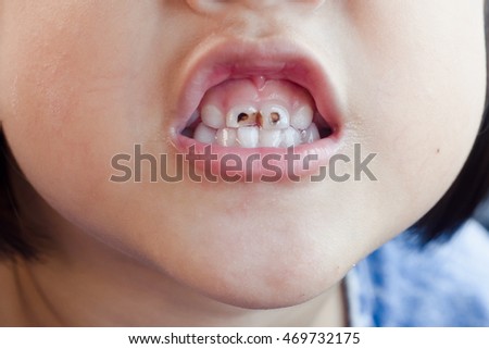 Child tooth decay.
smiling children.
 Royalty-Free Stock Photo #469732175