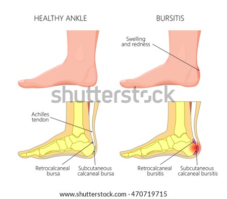 free haglund's deformity