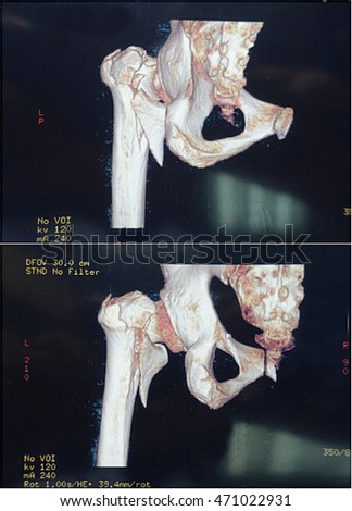 Special photography, hip fracture X-ray CT scanning, 3 d images                               