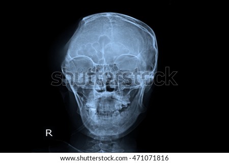 xray skull show post operation craniotomy