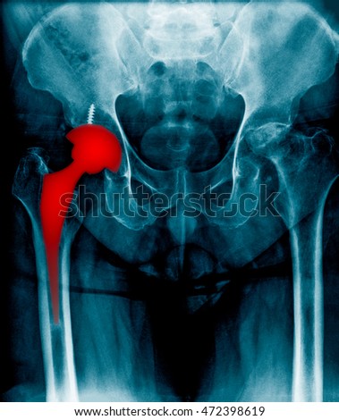 immediate postoperative x-ray image of both hip, anteroposterior view. Showing total hip prosthesis on right side. Royalty-Free Stock Photo #472398619