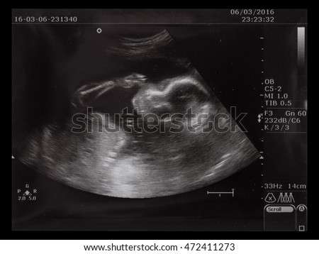 Ultrasonography picture