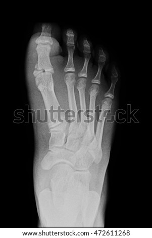 closed fracture right foot