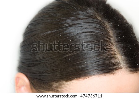 Dandruff and greasy hair on the head of a young female Royalty-Free Stock Photo #474736711