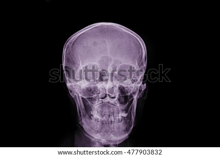 xray skull