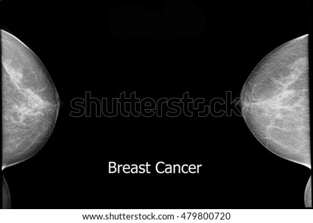 xray breast and breast cancer 