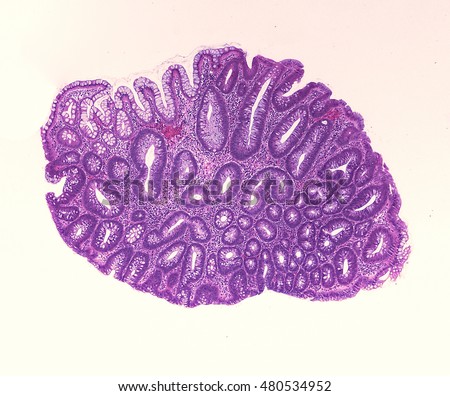  Microscopic image of an adenoma.  Adenomas are premalignant (precancerous) polyps of the colon and rectum.   Colonoscopy can prevent cancer by removing adenomas before they transform to cancer. Royalty-Free Stock Photo #480534952